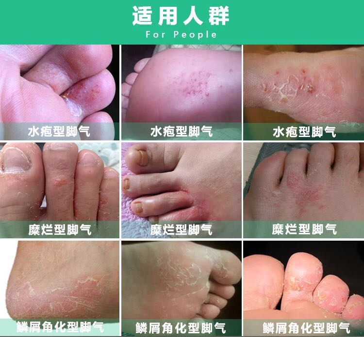 Beriberi Spray relieve itching Peeling Blister type Fungal infections Odor Sweaty feet Beriberi Nemesis Artifact Salvein the Localization of life services , Health Services , Foot/Bath/Massage category - from Buy2taobao.com to provide professional Taobao agent buy service