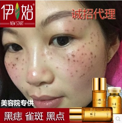 美容金水去痣点痣药水无痕正品祛痣膏痦子肉黑