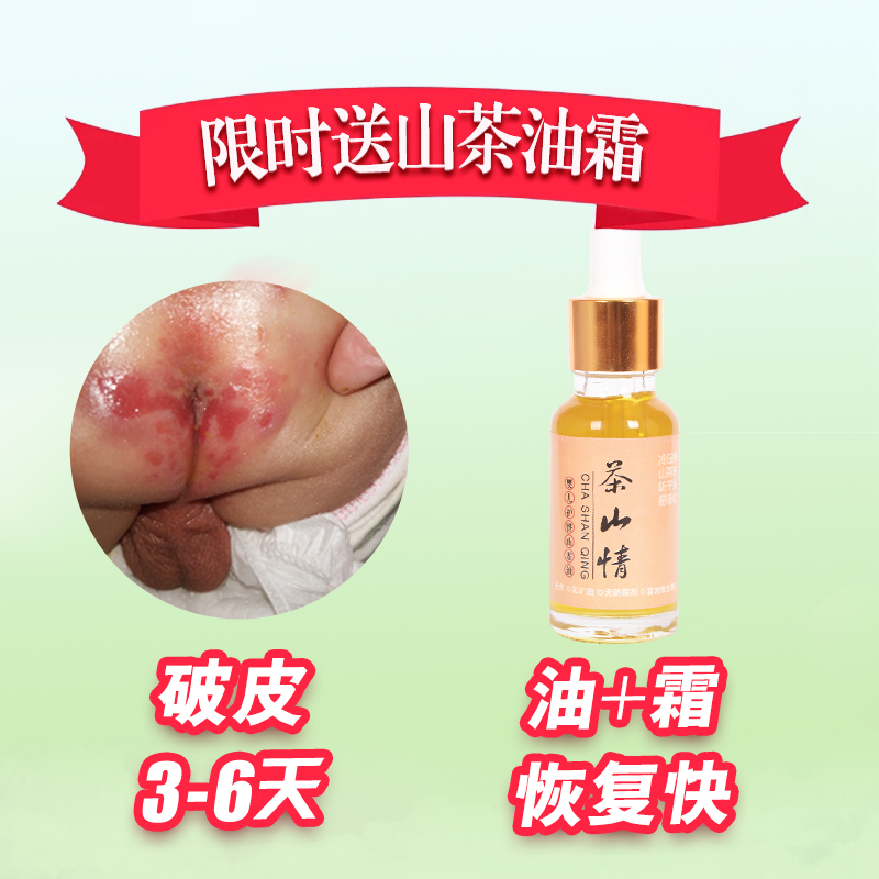 婴儿山茶油红屁股破皮修复护臀护肤宝宝按摩新生儿淹大腿天然油霜在类目 尿片/洗护/喂哺/推车床, 宝宝洗浴护肤品, 按摩油中 - 来自Buy2taobao.com提供专业的淘宝代购服务