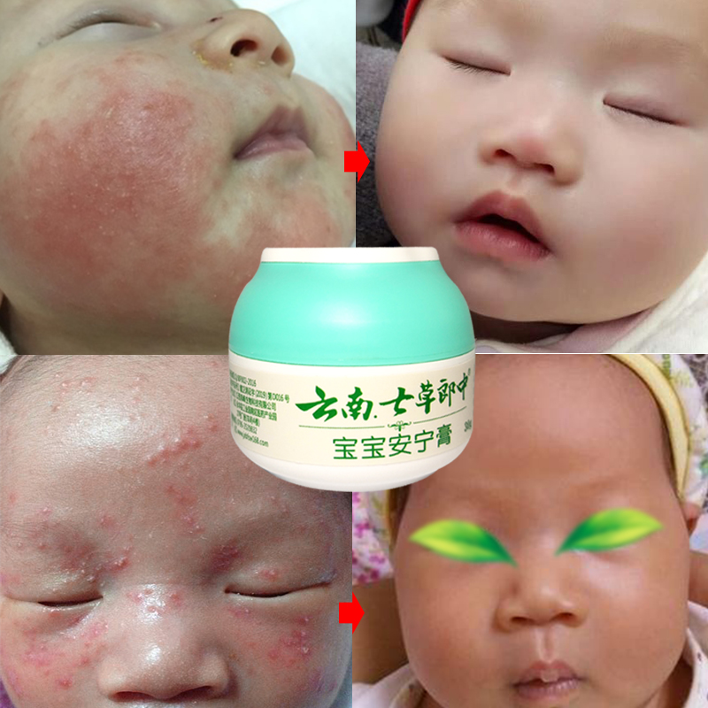 宝宝止痒膏蚊虫叮咬抑菌霜婴儿草本不刺激口水热痱子疹儿童湿诊乳在类目 尿片/洗护/喂哺/推车床, 驱蚊退烧用品, 止痒膏中 - 来自Buy2taobao.com提供专业的淘宝代购服务