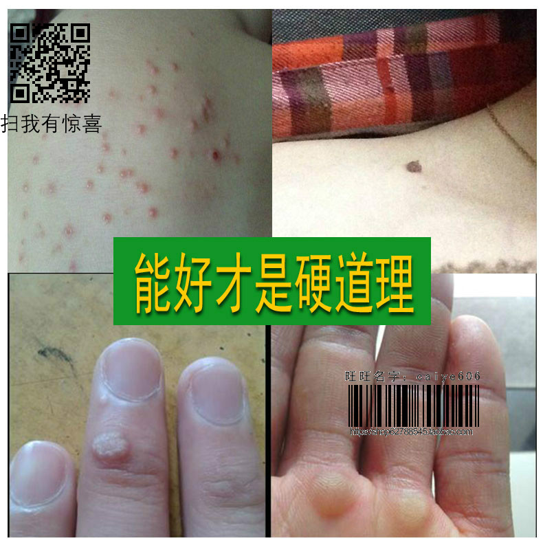 扁平疣面部特效去除手脸脖丝状疣必治祛刺瘊子猴子肉刺跖尤净灵膏在类目 个性定制/设计服务/DIY, 包装用品定制, 其它定做类中 - 来自Buy2taobao.com提供专业的淘宝代购服务