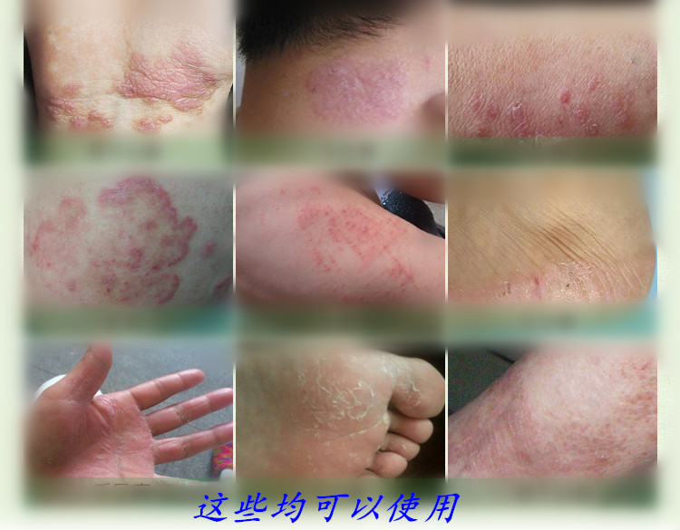 脚癣膏手足癣真菌感染止痒水泡型脚痒水泡脱皮烂脚丫杀菌止痒药膏在类目 宠物/宠物食品及用品, 鸟类及用品, 医疗用品中 - 来自Buy2taobao.com提供专业的淘宝代购服务