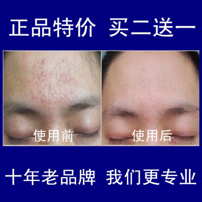 正品 去扁平疣特效药膏 面部 治扁平疣 眼部 克