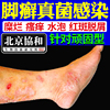 脚癣一次净泡脚喷剂脚气去止痒脚底脚藓真菌，感染根湿疹足癣藓wl