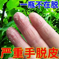 治疗手脱皮的药膏真菌，感染手指头手部鹅掌风，干裂手癣修复汗疱疹膏