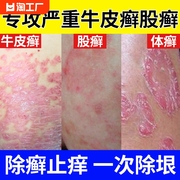 股藓大腿内侧根皮肤瘙痒真菌感染牛皮癣药体股癣去湿疹屁股止痒膏