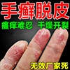手脱皮严重脱皮专用真菌蜕皮干燥起皮药膏护手霜，脱皮干裂用什么药