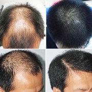 防脱发生发液增发密发脂溢性快速头发增长男女，育发囊活素掉发