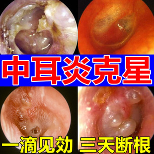 中耳炎特效药膏耳鸣耳朵流脓止痒消炎抑菌滴耳液人用可除根专用药