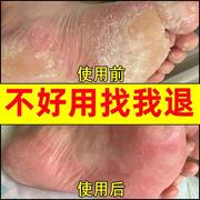 脚气真菌感染药膏脚后q跟手脚季节藓药膏真菌感染儿童特效专