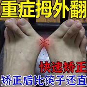 严重拇指外翻贴药膏大脚骨专用脚趾重叠矫正器突出囊炎治疗克星XA