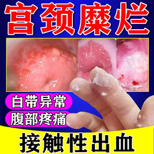 宫颈糜烂重度用专中药二度宫颈炎，出血腹腰背，坠痛妇科炎症抑菌凝胶