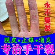 手干裂脱皮真菌感染干燥粗糙瘙痒裂痕治防脚裂神器治手裂的止痒药