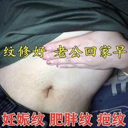 去妊娠纹肚子妊辰纹，产後消除x大腿肥胖纹生长纹预防紧致产後修复