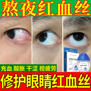 眼药水去红血丝抗疲劳滴眼液眼睛黄修复去除眼红眼部眼球有血丝BF