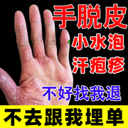 手脱皮药膏手癣膏真菌，感染鹅掌风干裂脱皮止痒抑菌膏治手裂的药膏