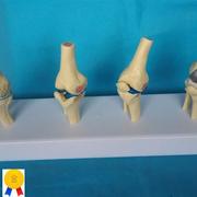 病变膝关节比较模型骨骼，骨架模型医用人体标本模型