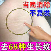 肥胖纹修复霜消除去肥胖纹，去除产后妊娠纹大腿，纹生长纹路淡化神器