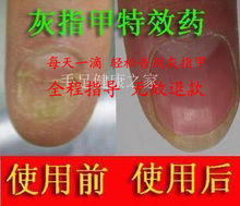 全程指导 灰指甲水 一天一滴简单方便  轻松消除灰指甲