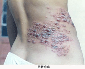 带状疱疹-蜘蛛疮、蛇串疮、火带丹、蛇丹、飞