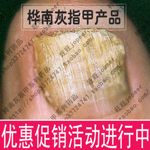 灰指甲！桦南灰指甲修护液！万千好评！强效新型！快速！2瓶包邮