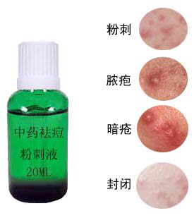  袪  痘  产品  中药祛 痘 粉刺液  痘  痘 1天可见效 [脸上重度红头粉刺专用]