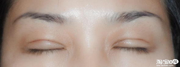 <em>韩式微创双眼皮</em>恢复过程 二十天 更新中. - 整形