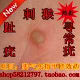 足宝堂 趾疣 寻常疣 瘊子 肉刺 跖疣特效专用