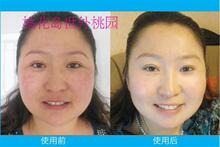 补水美白祛斑祛皱去黑眼圈提升脸部轮廓一疗程签约服务无效退款