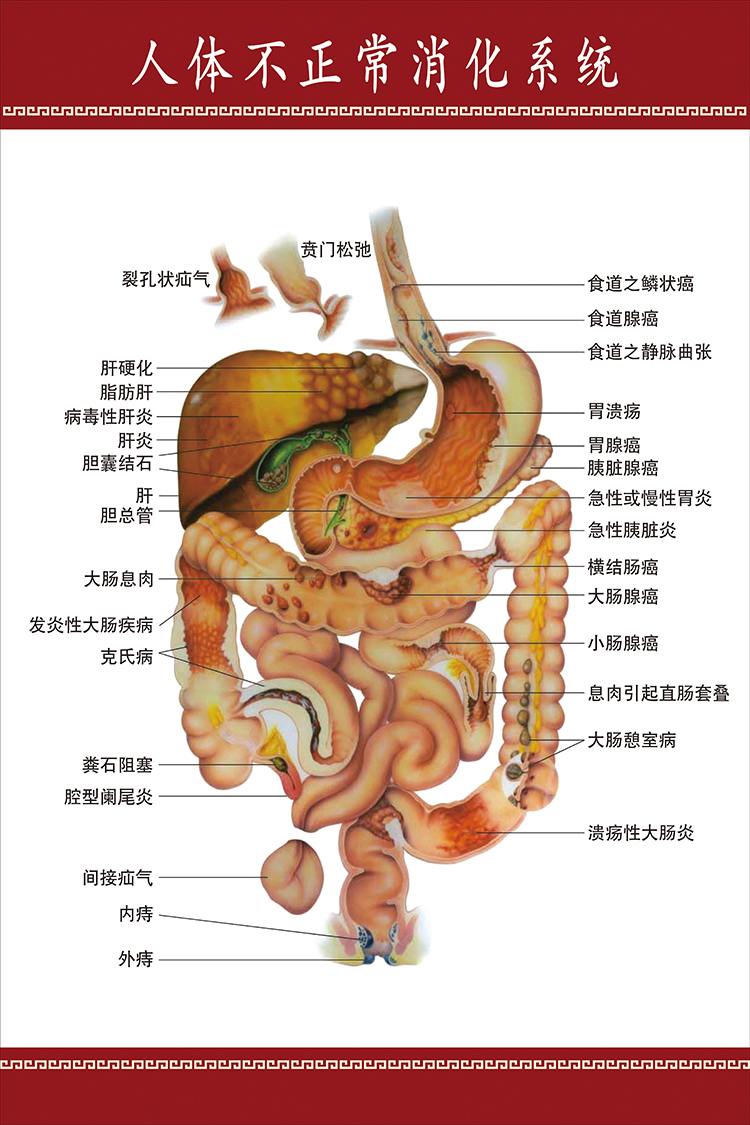 人体不正常的消化系统示意图 内脏分部图人体解剖图医院宣传挂图