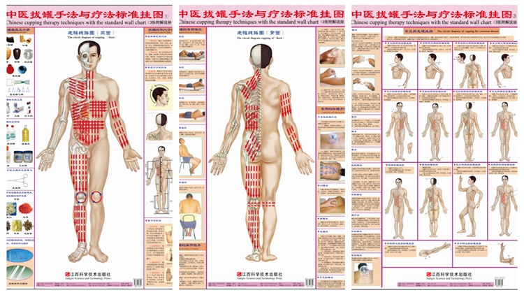 中医养生 权健火疗海报 挂图 kt板定制火疗的调