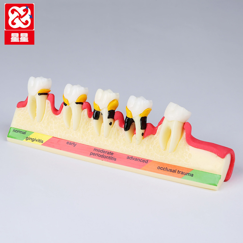 Jining stars dental periphery classification Model dental periphery Process Stomatology Department Patient communicate Exhibition Modelin the Personal Care/Health/Massage equipment , Oral Care , Other oral therapy equipment category - from Buy2taobao.com to provide professional Taobao agent buy service