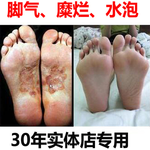 中药治疗脚气膏去除脚痒水泡脚烂脱皮烂脚丫手