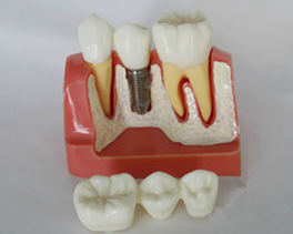 种植体分解模型 口腔模型 牙齿解剖模型 儿童教