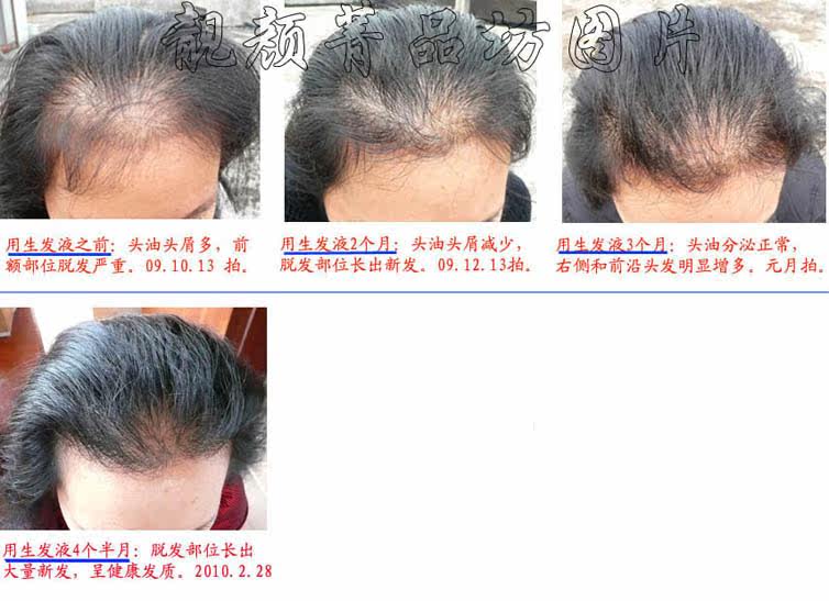 效林氏生发膏 中药生发 防脱发、斑秃、<em>产后</em>脱