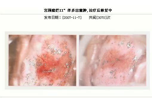 妇科病臭氧治疗仪器 妇科治疗仪根除妇科疾病